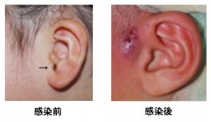 耳前瘻孔　感染前　感染後